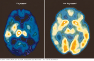 Brain Scan of Depressed Person